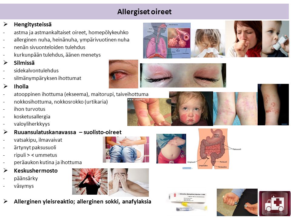 Allergiset oireet  Hengitysteissä -astma ja astmankaltaiset oireet, homepölykeuhko -allerginen nuha, heinänuha, ympärivuotinen nuha -nenän sivuonteloiden tulehdus -kurkunpään tulehdus, äänen menetys  Silmissä -sidekalvontulehdus -silmänympäryksen ihottumat  Iholla -atooppinen ihottuma (ekseema), maitorupi, taiveihottuma -nokkosihottuma, nokkosrokko (urtikaria) -ihon turvotus -kosketusallergia -valoyliherkkyys  Ruuansulatuskanavassa – suolisto-oireet -vatsakipu, ilmavaivat -ärtynyt paksusuoli -ripuli > < ummetus -peräaukon kutina ja ihottuma  Keskushermosto -päänsärky -väsymys  Allerginen yleisreaktio; allerginen sokki, anafylaksia