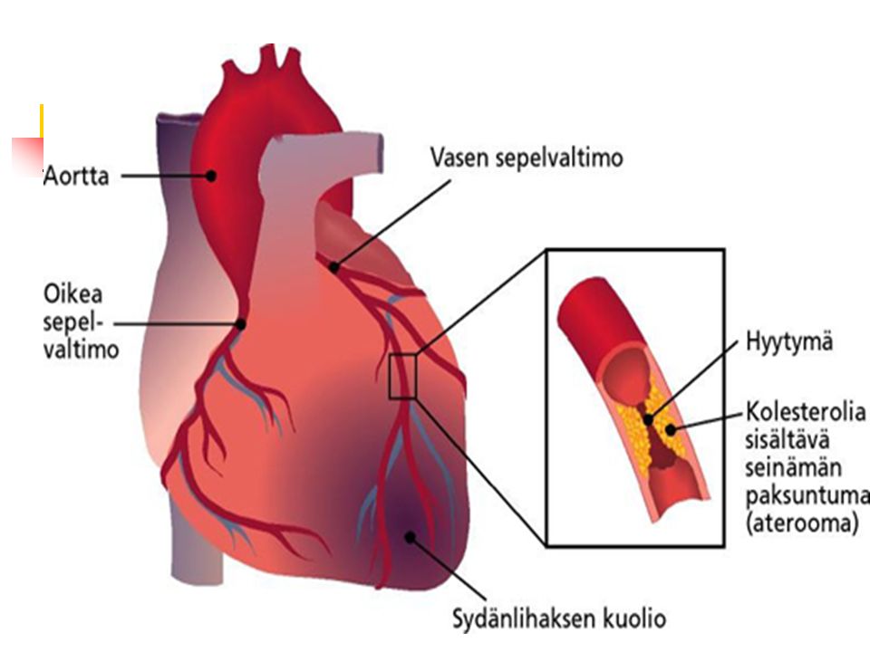 sydänlihaksen iskemia oireet